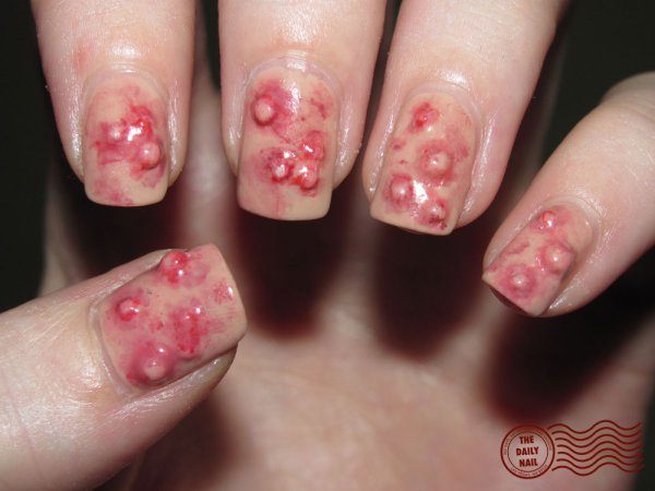 wart nails