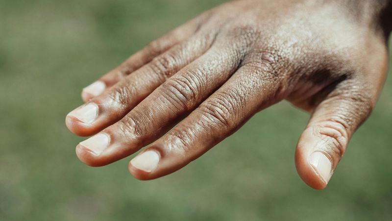Cracking Knuckles Causes Arthritis Later