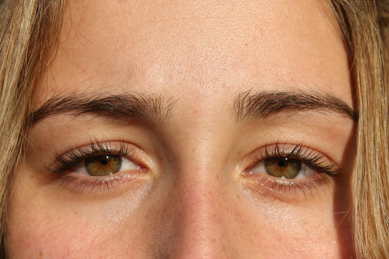 Distichiasis: An Extra Row of Eyelashes